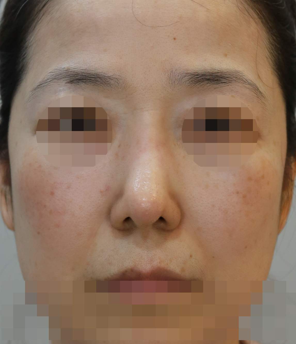 무보형물 코재수술; 늑연골 제거, 보형물 제거 수술전