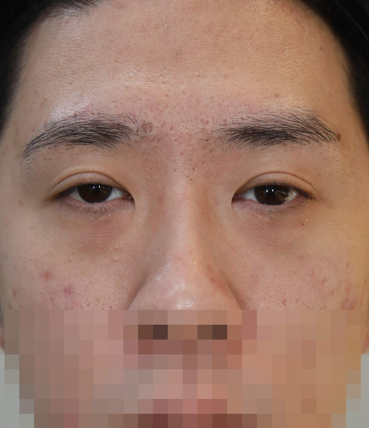 쌍꺼풀 라인 낮추기; 두줄따기 수술전