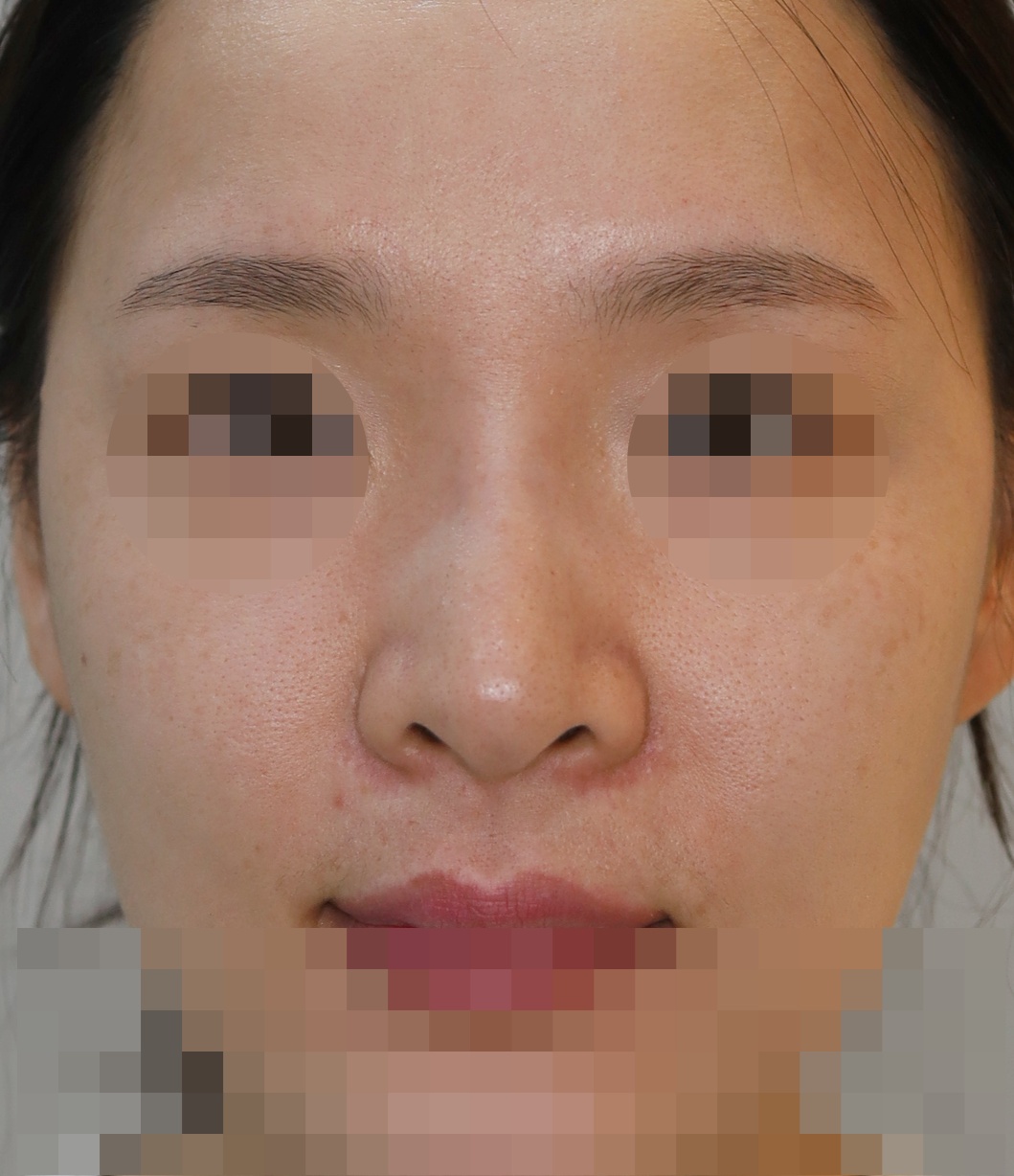 에버코 제거, 무보형물 코성형; 용코 교정 2개월 수술전
