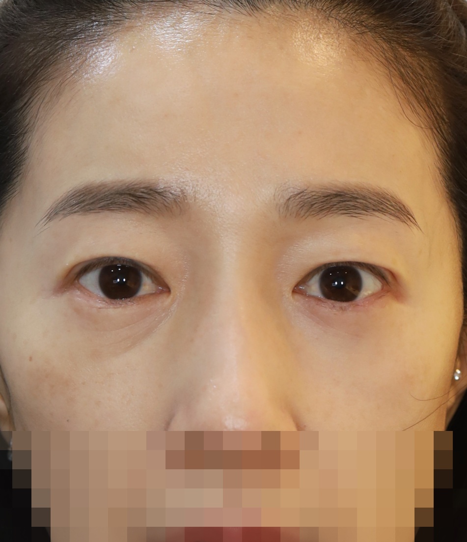 두줄따기, 눈두덩이 지방이식 5개월 수술후