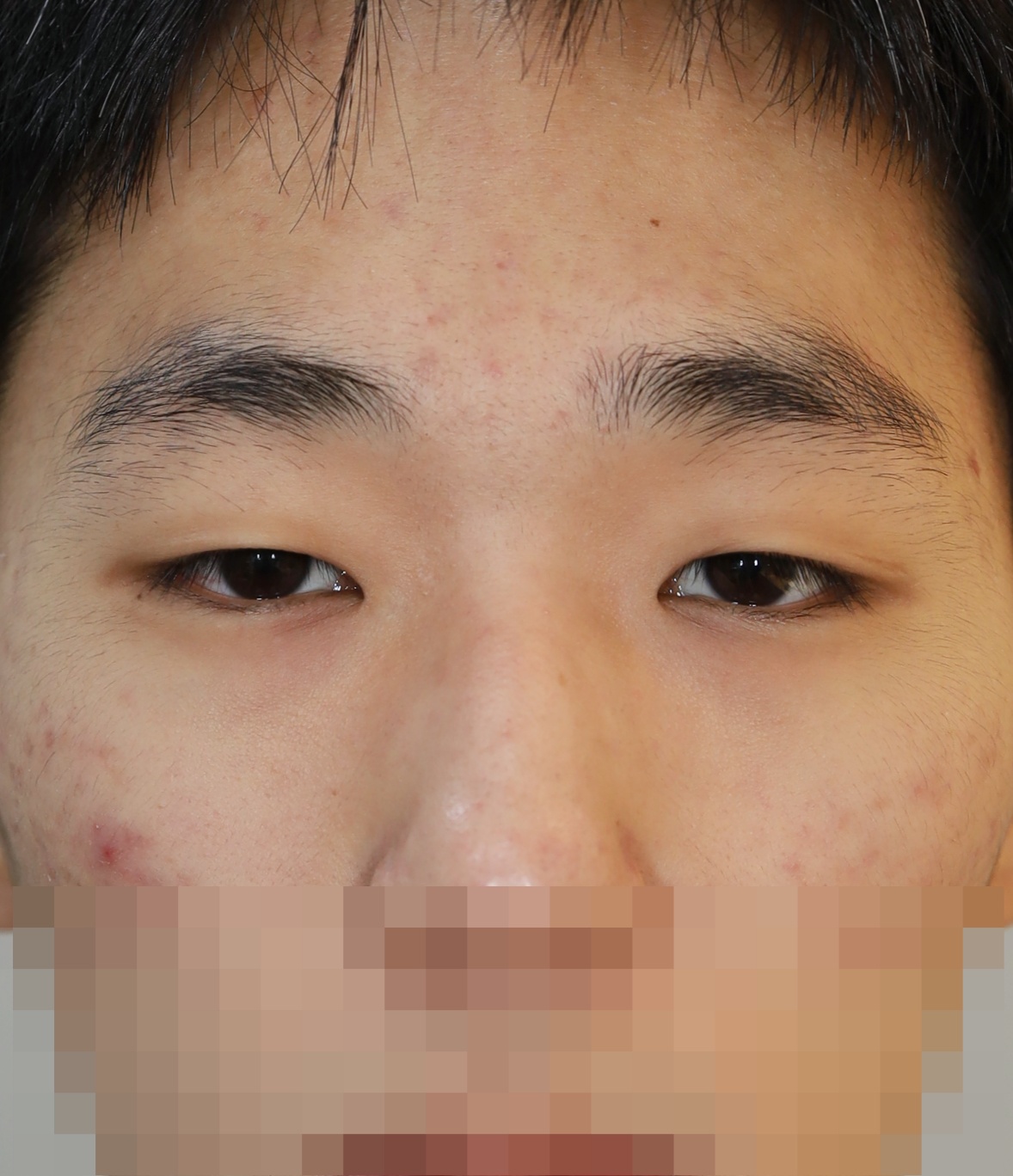 비절개 눈매교정, 위트임, 안검내반 교정 3개월 수술전