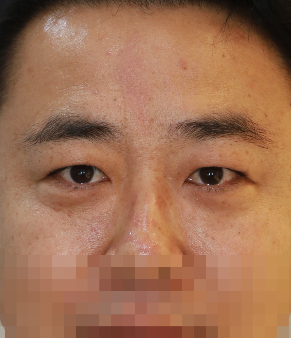 비절개 쌍꺼풀, 눈밑 지방 재배치 수술후