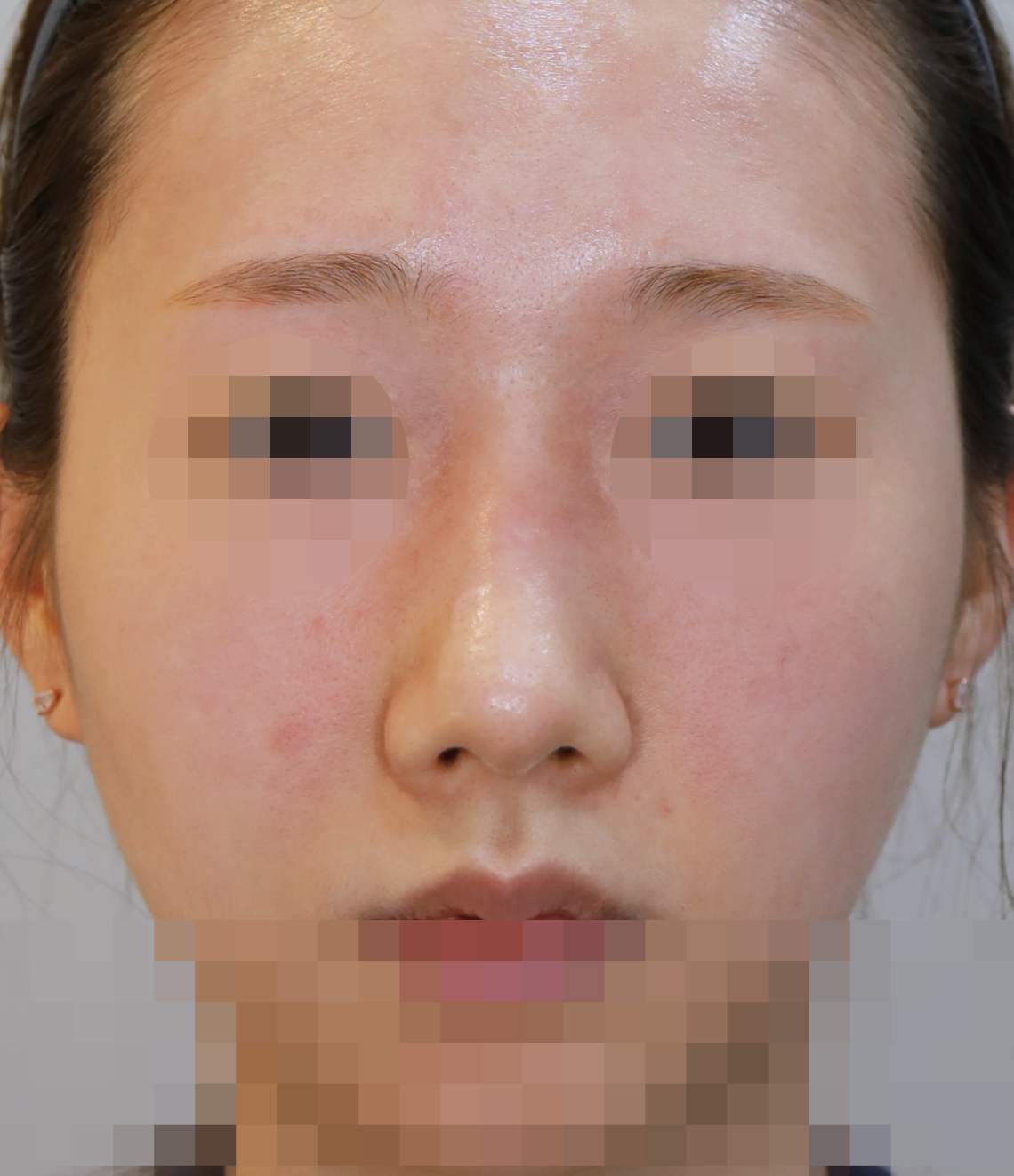 무보형물 코성형; 휜코 교정, 매부리 교정 수술후