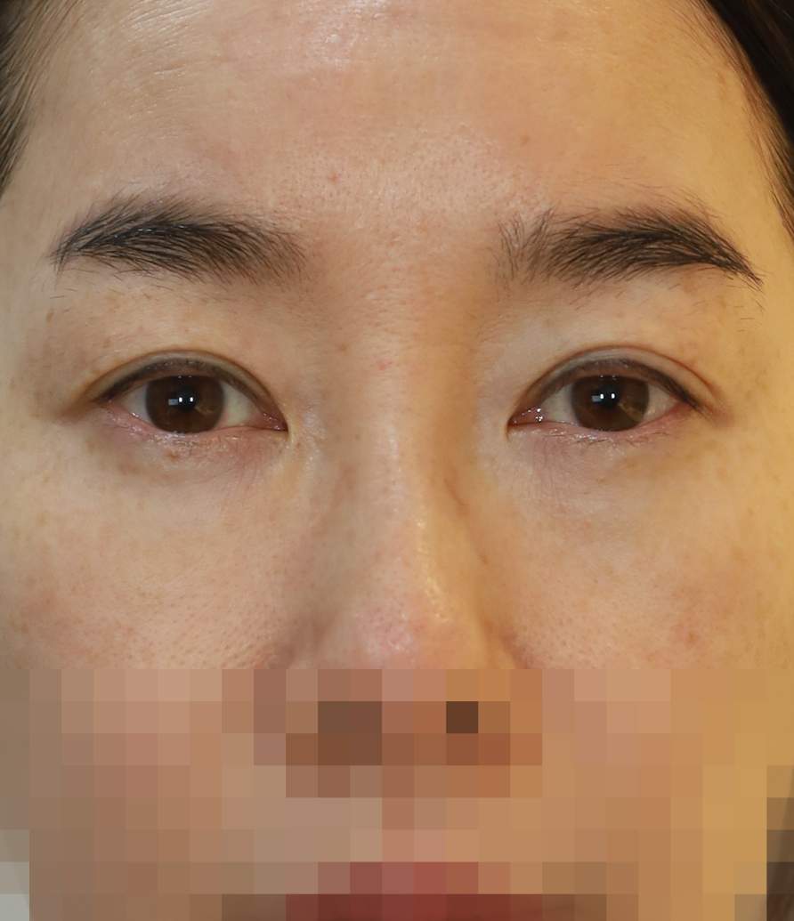 쌍꺼풀 라인 낮추기, 안검하수 교정 수술전