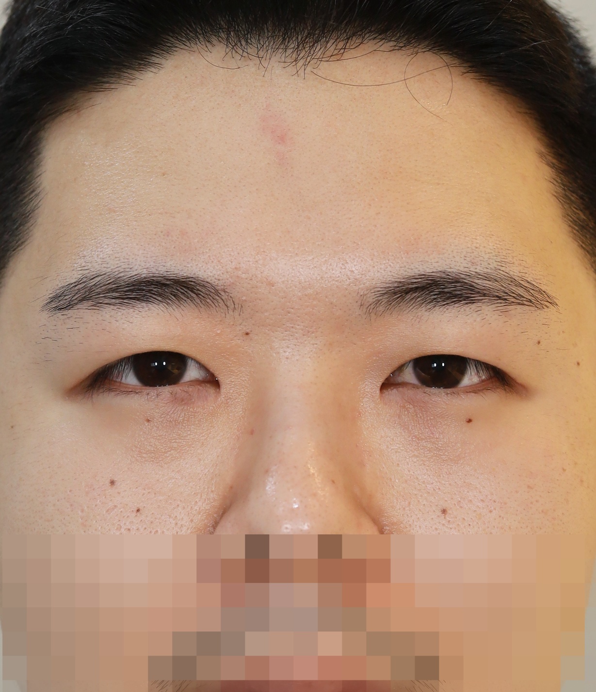 절개 쌍꺼풀, 앞위트임 3개월 수술후