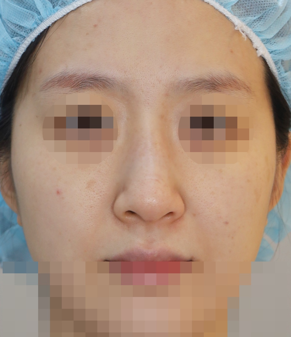 무보형물 코성형; 매부리 교정, 휜코 교정 1년 수술전
