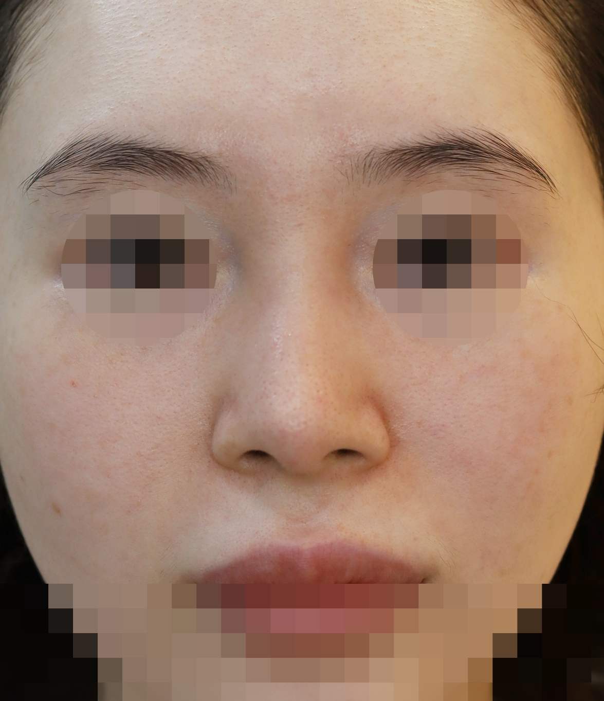 콧볼 재배치 2주 수술전