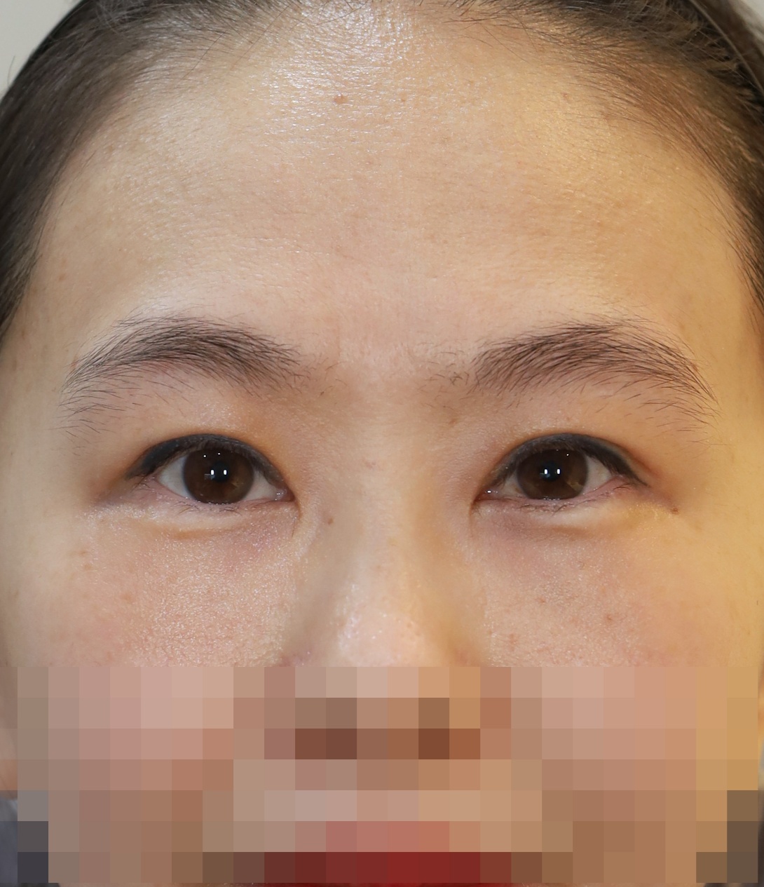 쌍꺼풀 라인 낮추기, 눈위 지방 재배치 수술후