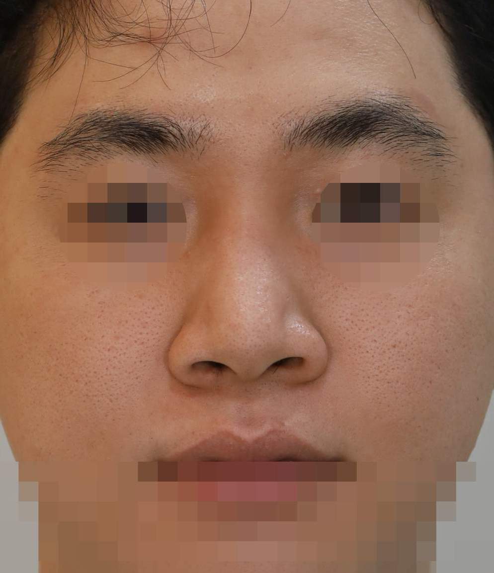 무보형물 코성형; 비주내리기, 콧볼축소 수술전