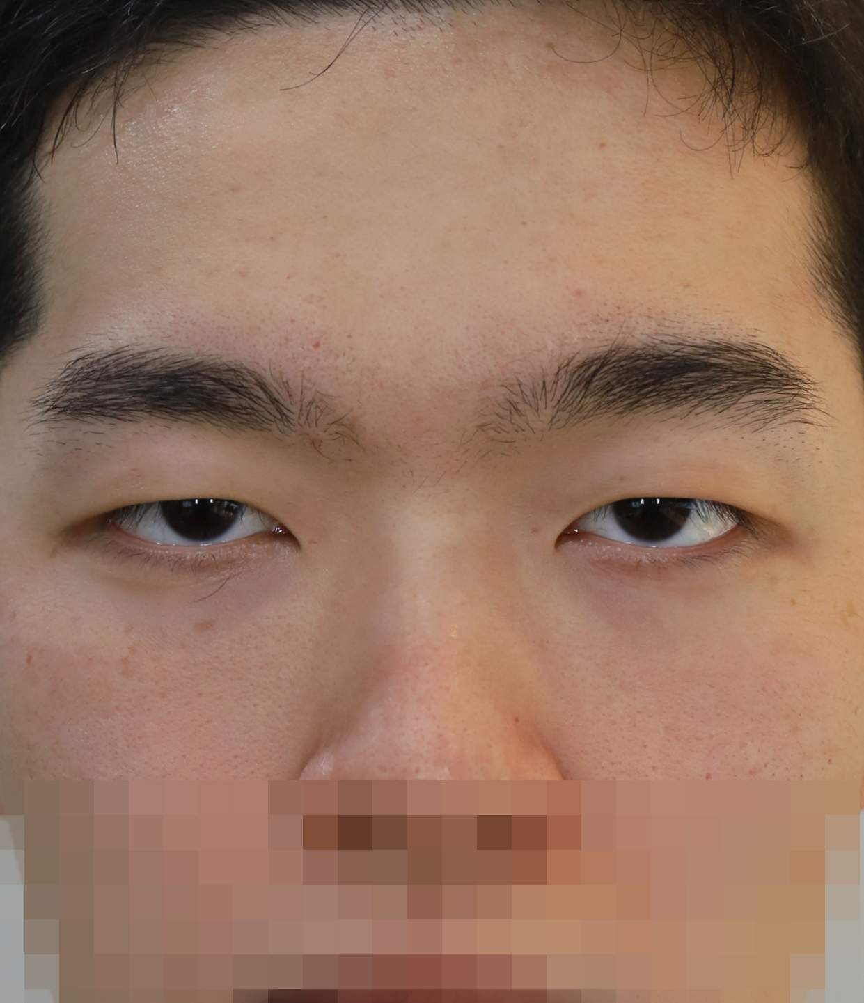 비절개 쌍꺼풀 3개월 수술전