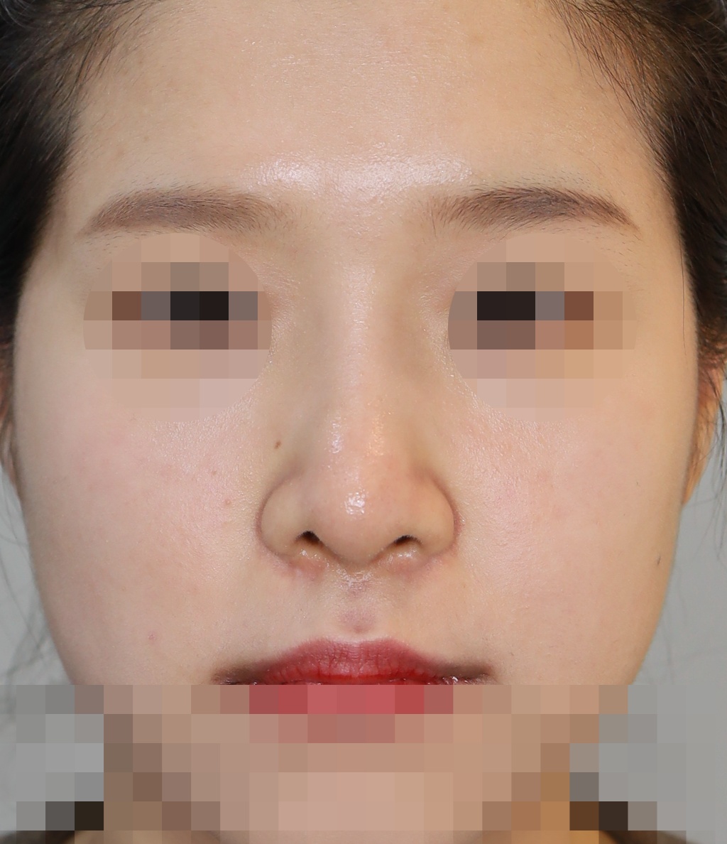 콧대(일반보형물), 코끝(귀연골) 3개월 수술후