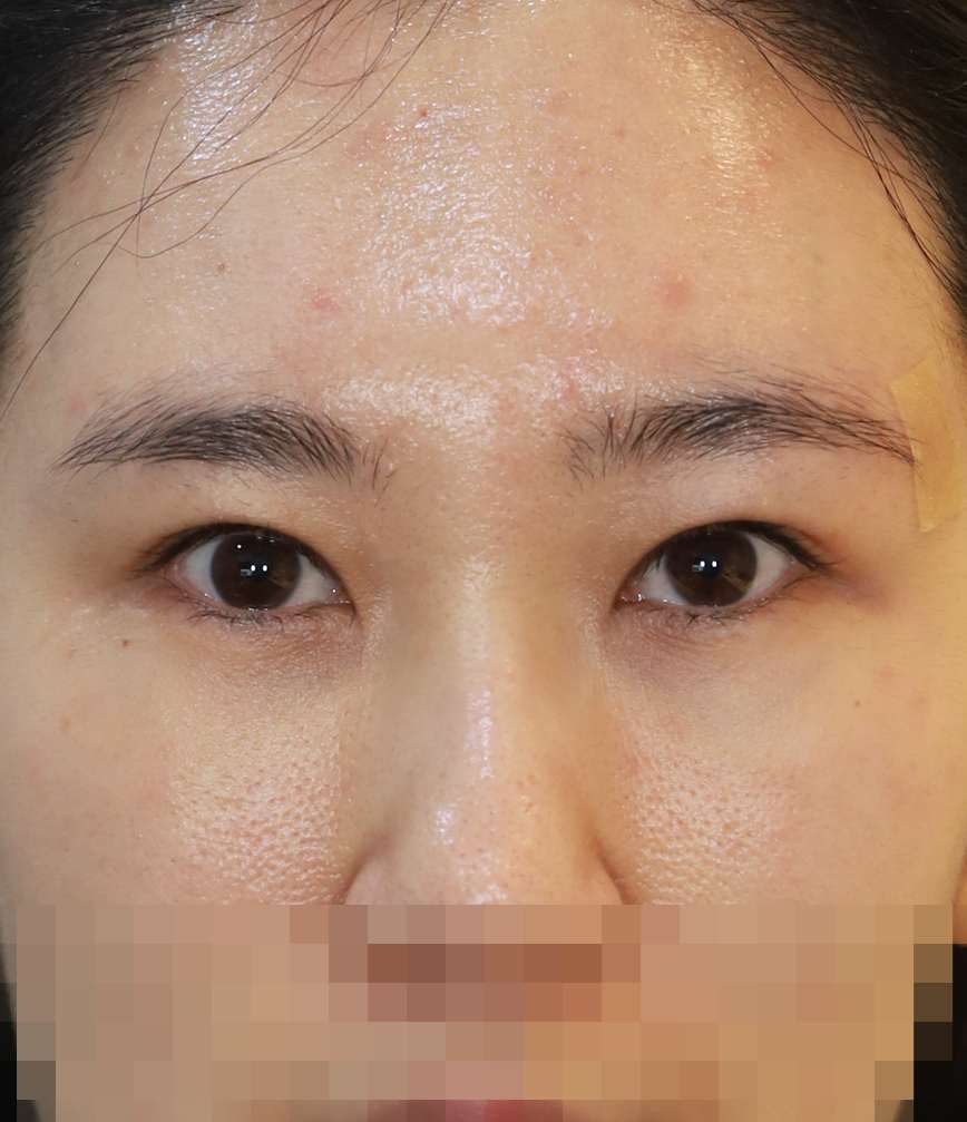 쌍꺼풀 라인 낮추기; 두줄따기 4개월 수술후