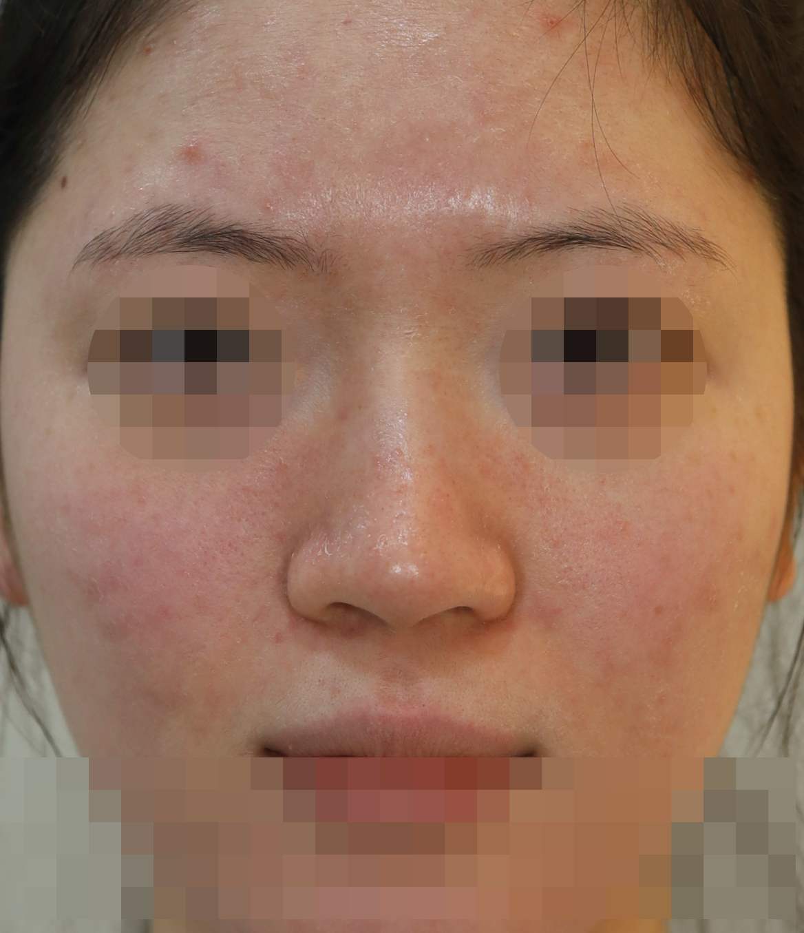 무보형물 코성형; 비주내리기 수술전