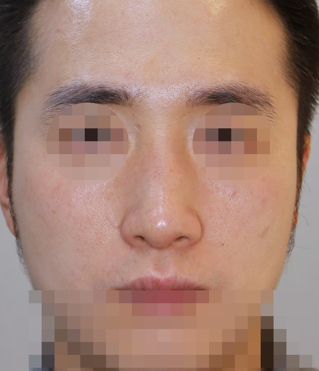 휜코 교정, 매부리 교정 3개월 수술후