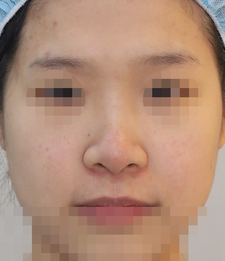 콧대(일반보형물), 코끝(귀연골) 3개월 수술전