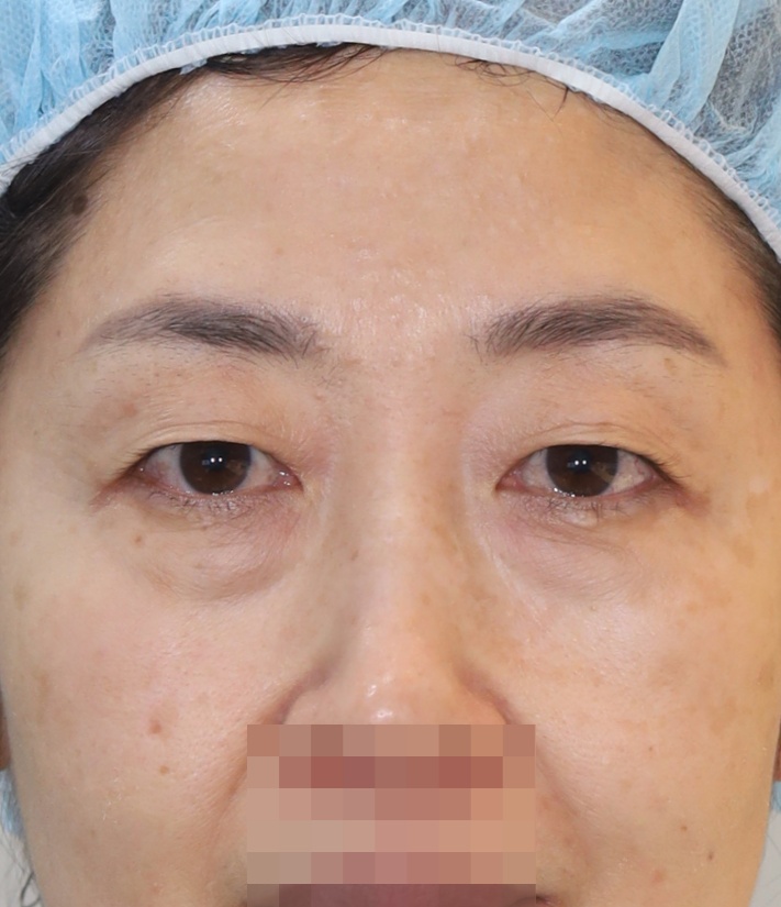 눈썹 밑 거상, 비절개 쌍꺼풀, 중안면 거상 4개월 수술전