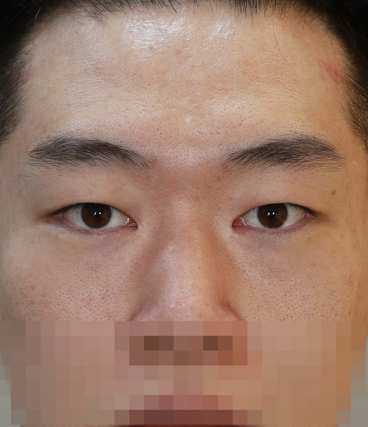 쌍꺼풀 라인 낮추기; 두줄따기, 앞트임 비대칭 교정 3개월 수술후