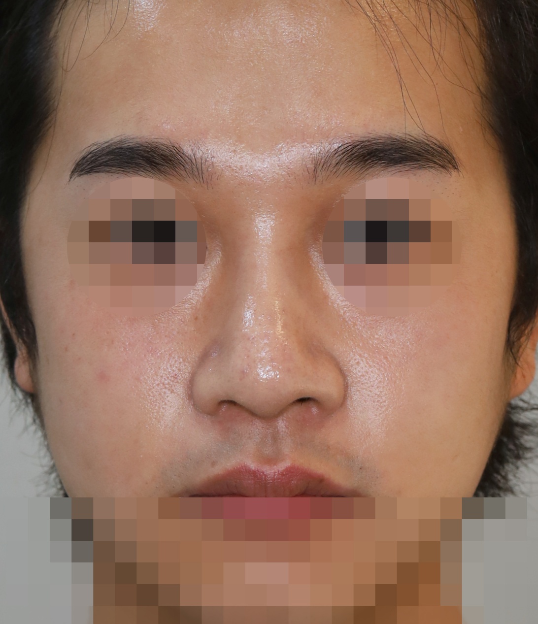 콧대(맞춤보형물), 코끝(귀연골), 비주내리기 5개월 수술후