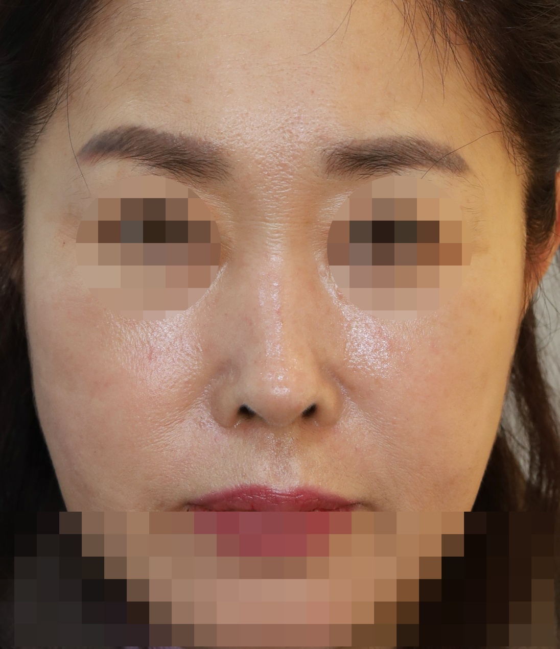 무보형물 코성형; 용코 교정, 비공내리기 수술후