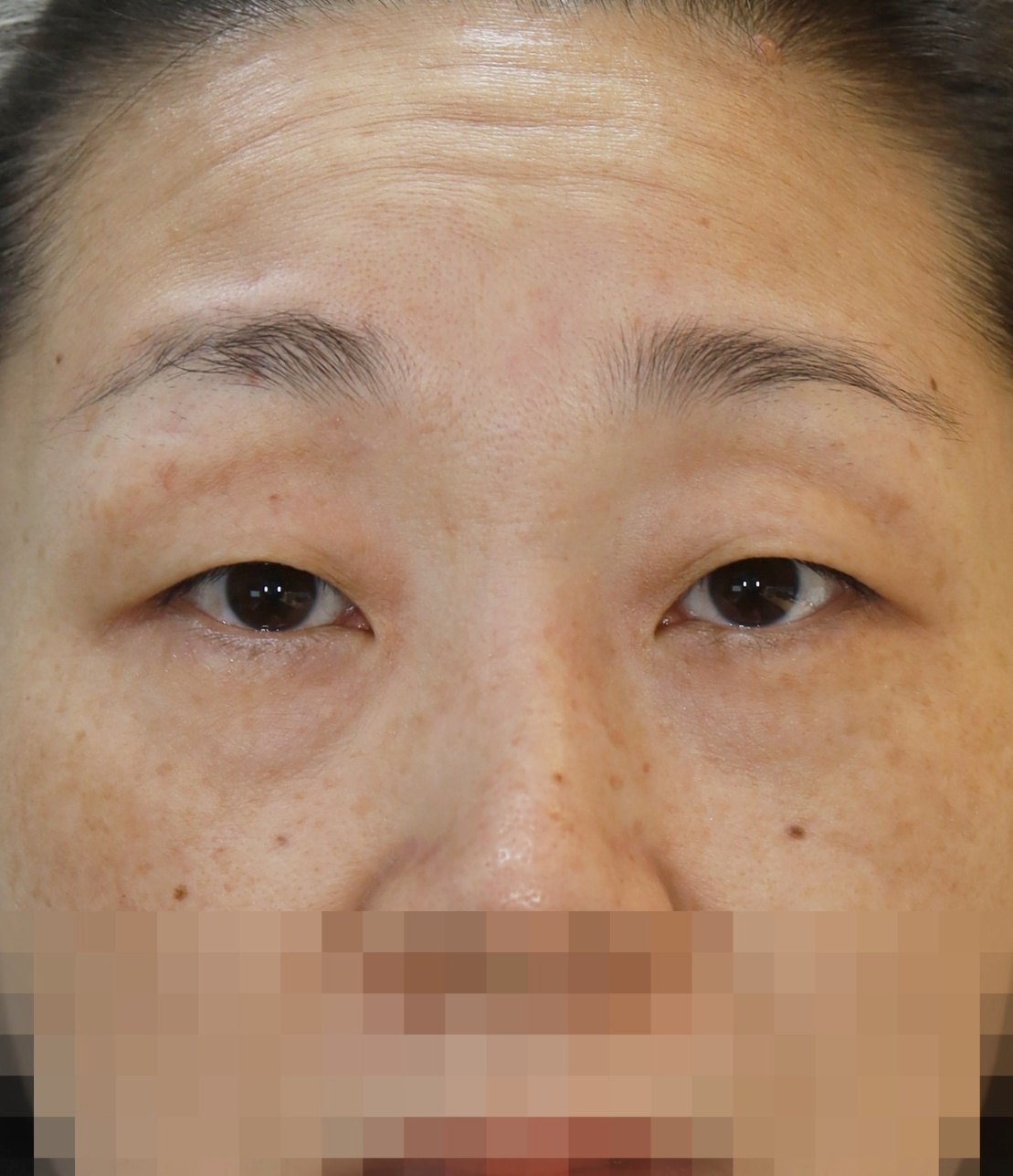 절개 쌍꺼풀, 눈썹 하 거상, 눈밑 지방 재배치 2년 수술전
