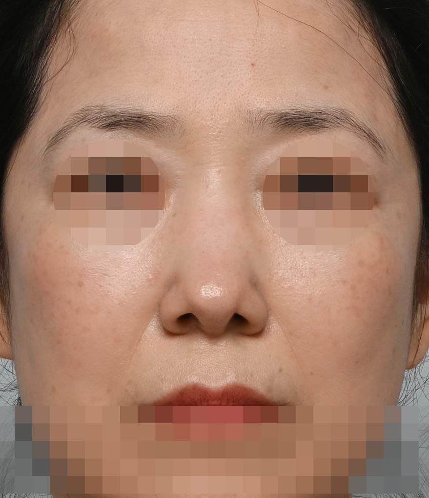 무보형물 코재수술; 늑연골 제거, 보형물 제거 수술후
