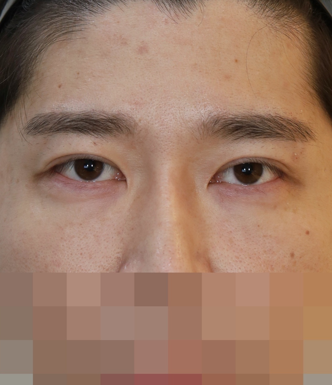 쌍꺼풀 라인 낮추기; 두줄따기 수술전