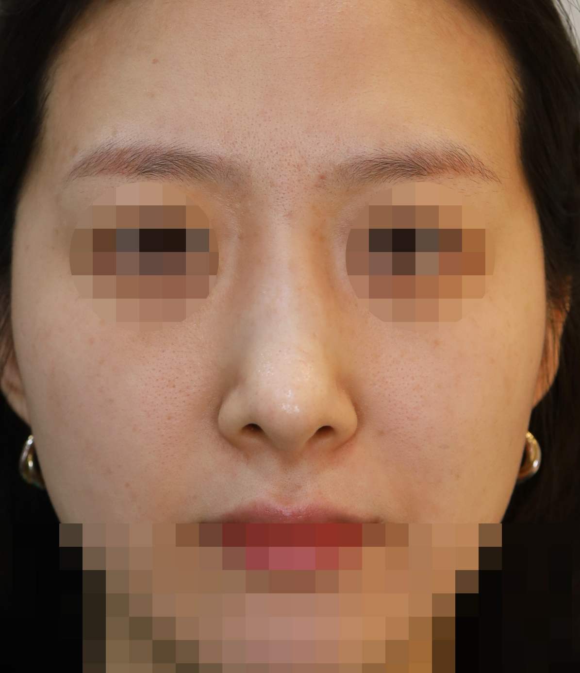 무보형물 코성형; 매부리 교정, 휜코 교정 1년 수술후