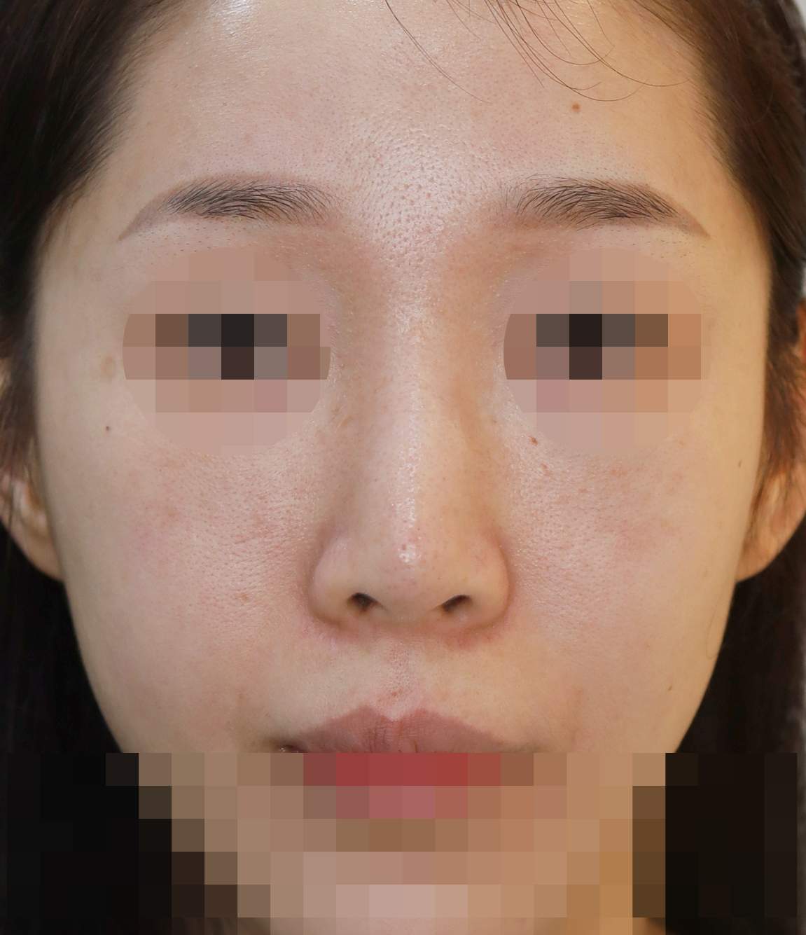 무보형물 코재수술; 눌린코 교정 수술전