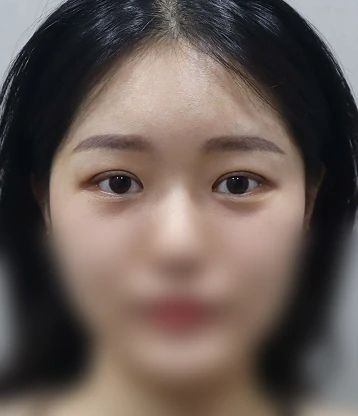 after 사진