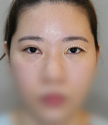 before 사진