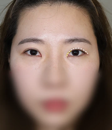 after 사진
