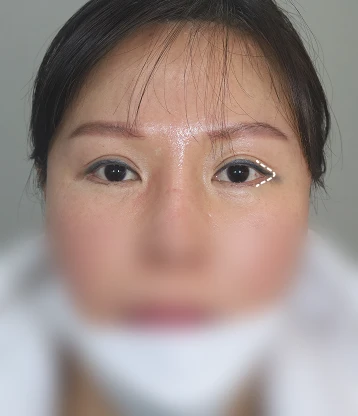 after 사진